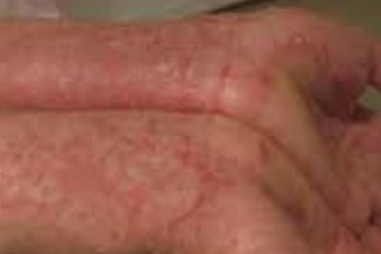 طفح جلدي أو ندوب حمراء، وقد تترافق مع حكة أو ألم