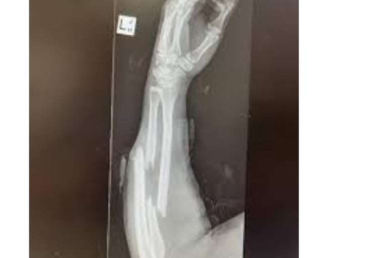 Why do some break when they fall down Without Getting Injured (1)