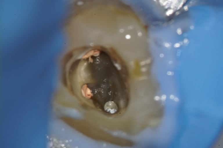 Missed root canal treatment visible under microscope by Dr. Paras Kothari