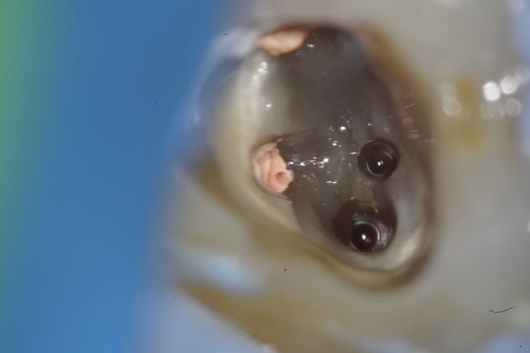 Cleaning of missed root canal under dental microscope