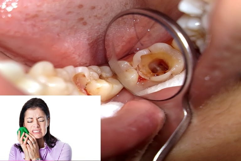 sâu răng gây đau răng