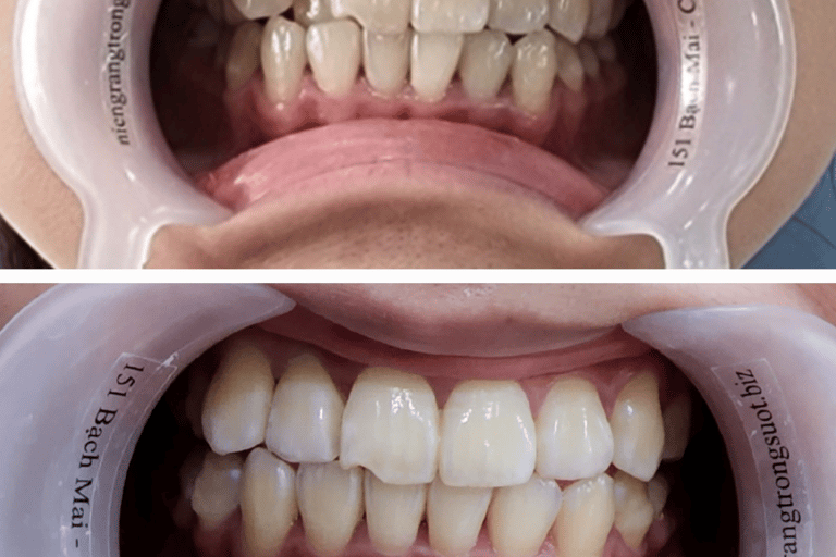 niềng răng invisdental