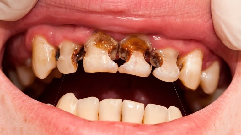 viêm niếu do sâu răng