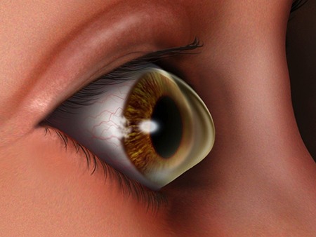 keratoconus-scleral-lens-orthokeratology