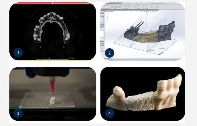 Proceso MimetikOss 3D Keylife
