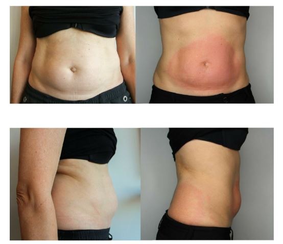 Cryolipolyse avant apres Ventre femme