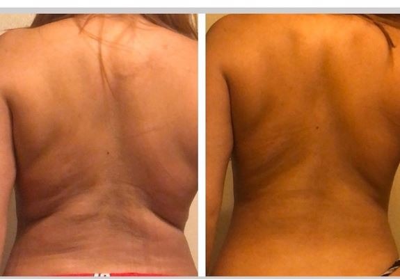 Cryolipolyse avant apres