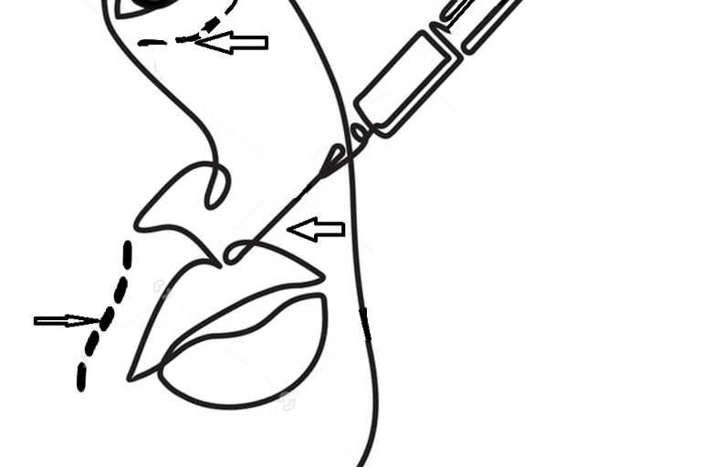 Filler injection sites for facial contouring and volume restoration.