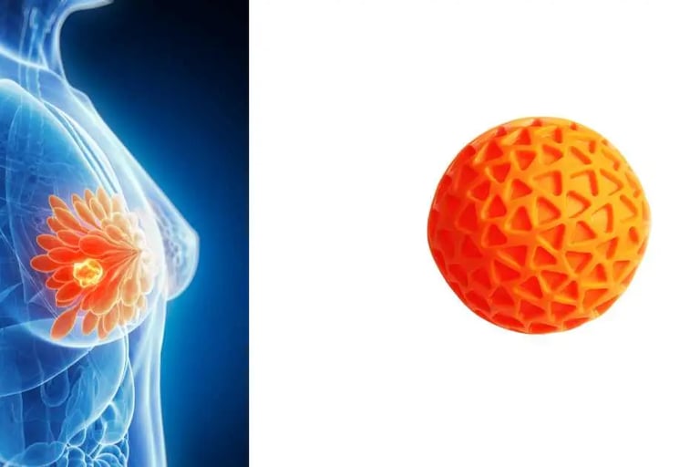 क्या स्तन में गांठ होना सामान्य है?