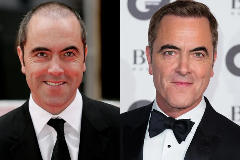 hair transplant james nesbitt
