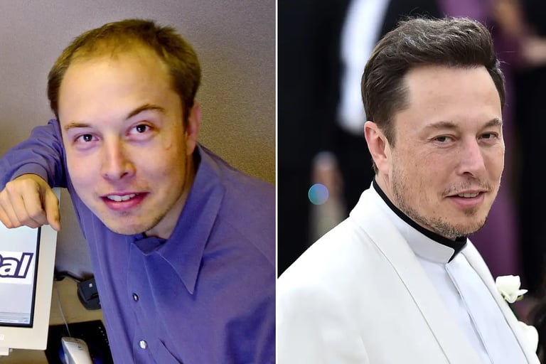 elon musk avat apres greffe capillaire