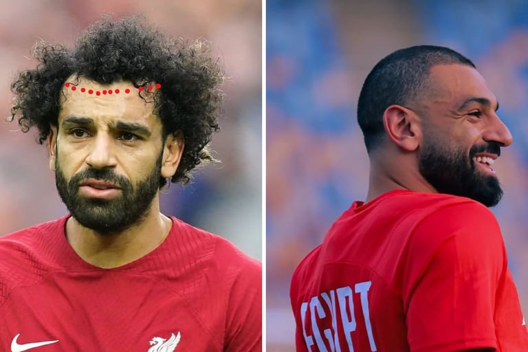زراعة الشعر محمد صلاح