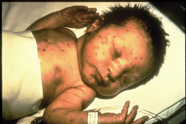 rubella
