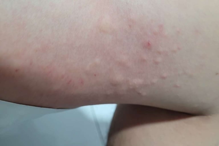 allergic reaction on skin that resembles bites