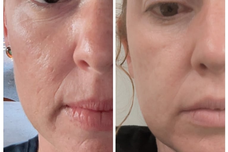 Before and after image of skin treated with mesotherapy and skin needling, salmon DNA.