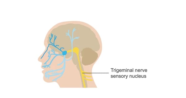 headache from neck pain