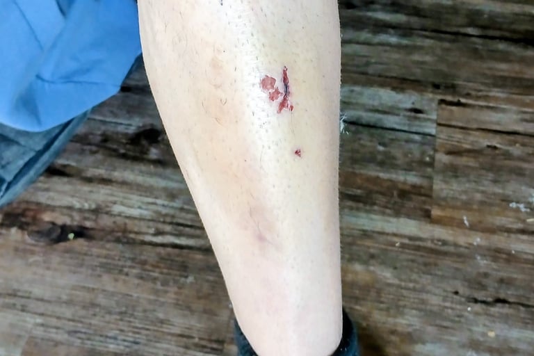cut on shin from pedal slip
