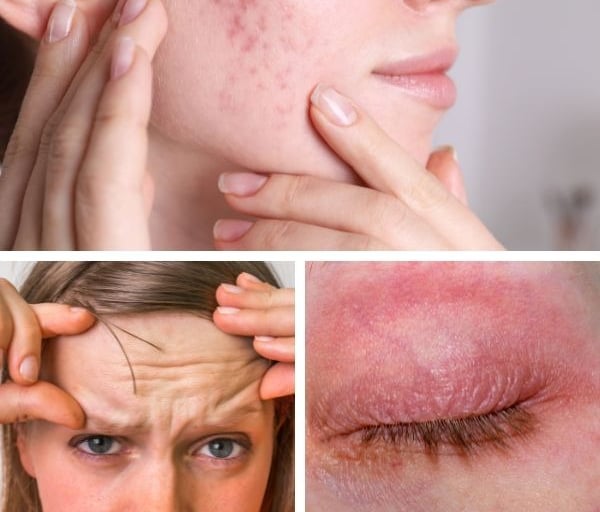 a woman with acne skin and a woman with acne