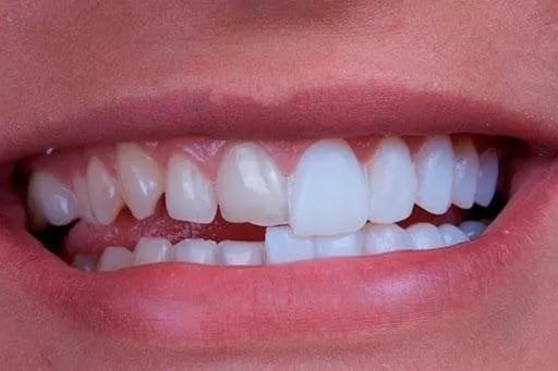 foto comparando dente com facetas