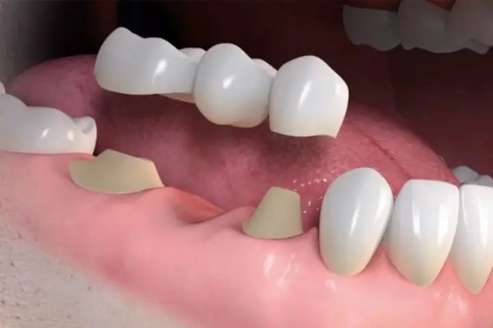 ilustração de prótese fixa sobre os dentes