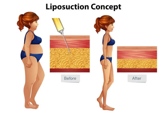 Liposuction in Lucknow