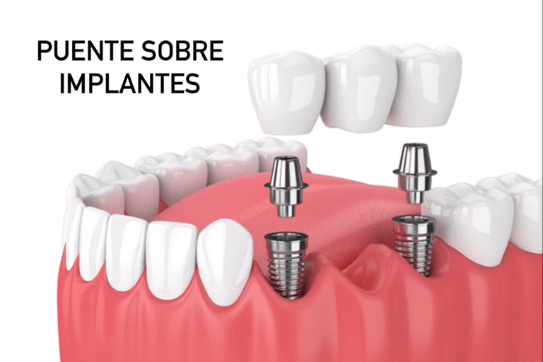 Puente sobre implantes