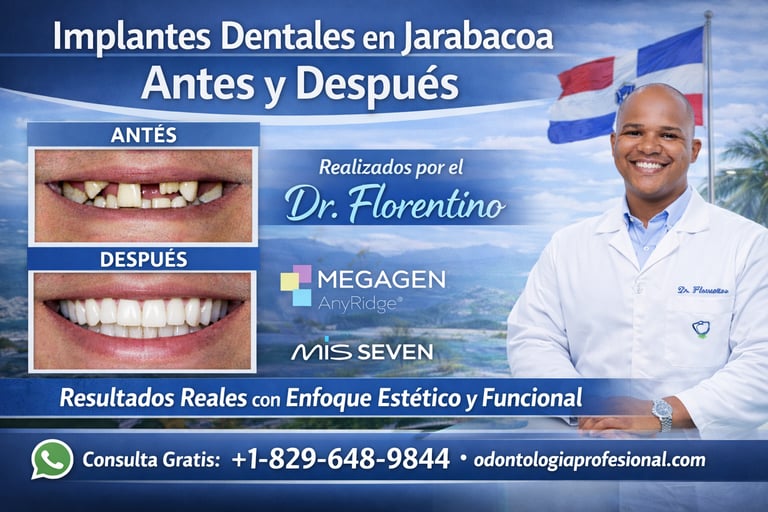 Implantes dentales en Jarabacoa antes y después realizados por el Dr. Florentino.