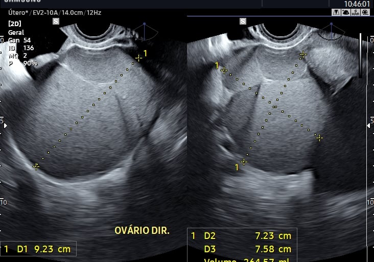 Endometriomas em paciente com dispareunia e dismenorreia