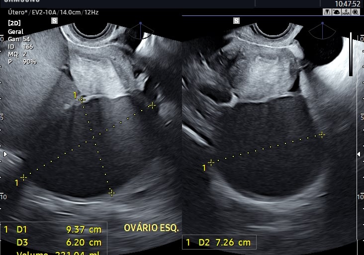 Endometriomas em paciente com dispareunia e dismenorreia