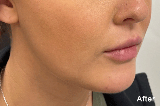 After QuantumRF Treatment