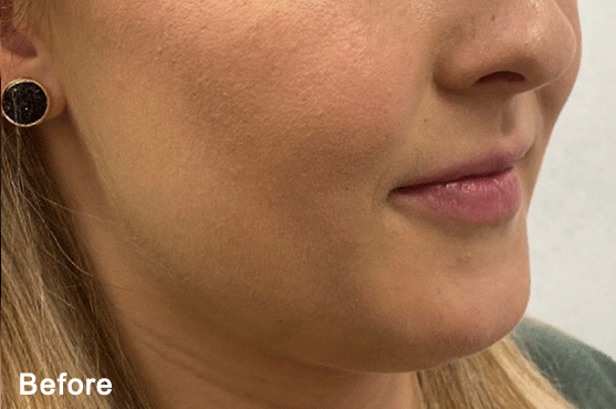 Before QuantumRF Treatment