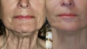 Botox Treatment Before and After