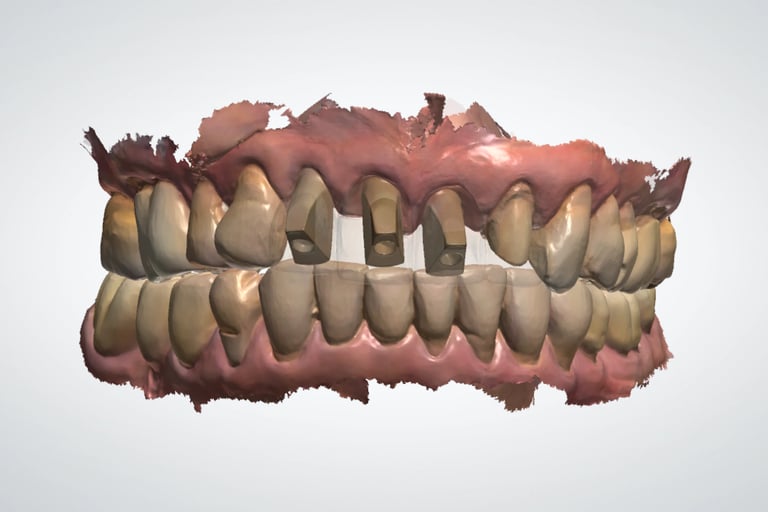 scan dental para implantes dentales