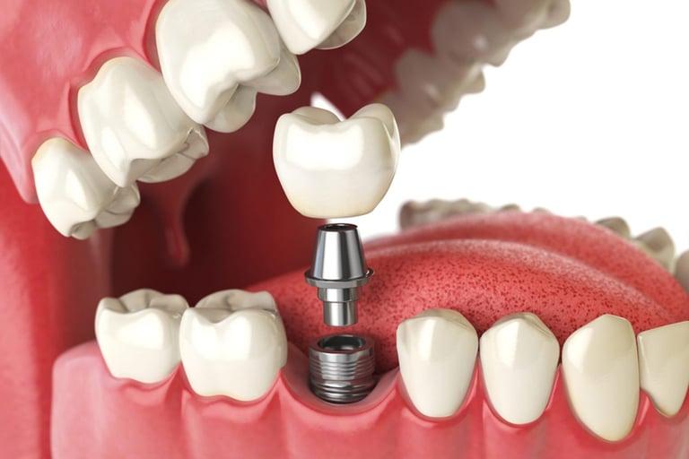 Dental Implant Treatment in Indore