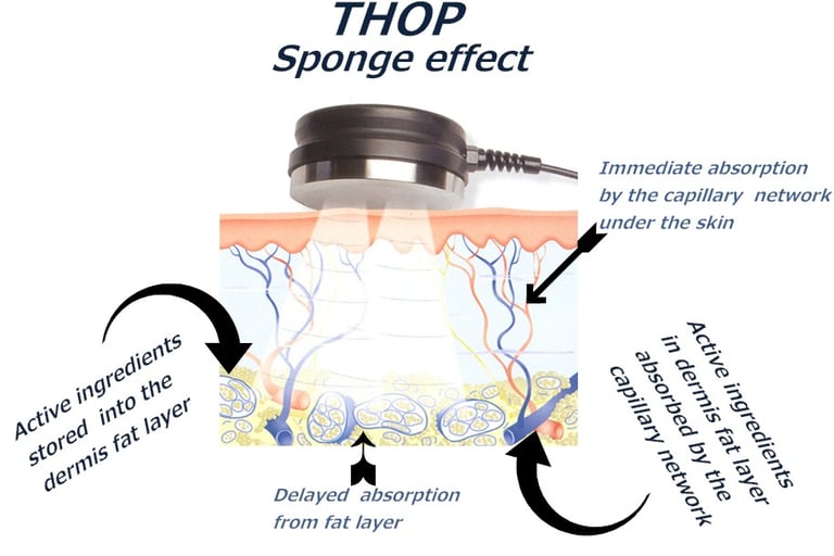 L'effetto Sponge della Sonoforesi