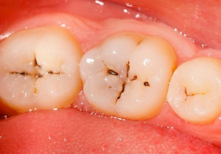 Tambal Gigi Estetik untuk Gigi Berlubang di Malang - Sidharta Dental Studio