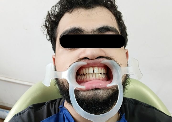 Fracture teeth post treatment at Rps Dental Clinic in Ranchi