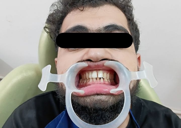 Lower fractured lateral incisor at Rps Dental Clinic in Ranchi