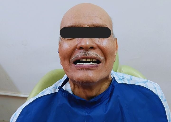 lower fix teeth at Rps Dental Clinic in Ranchi