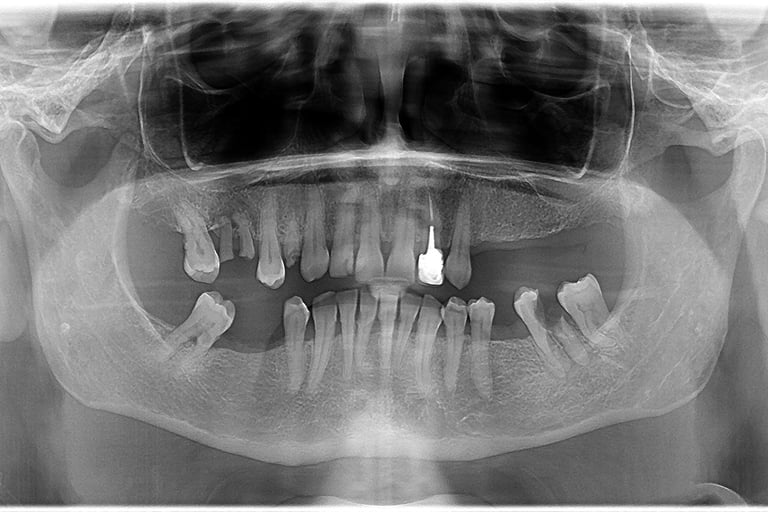 reabilitare orala implanturi