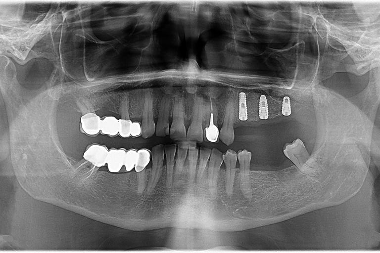 Sinus Lifting + Implantologie
