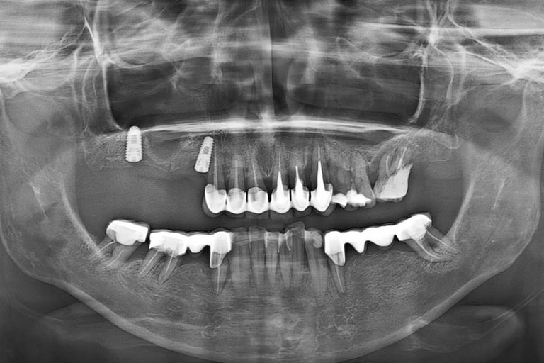 Implanturi dentare + sinus lift