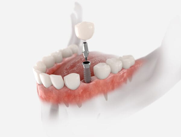 Inserare implant dentar
