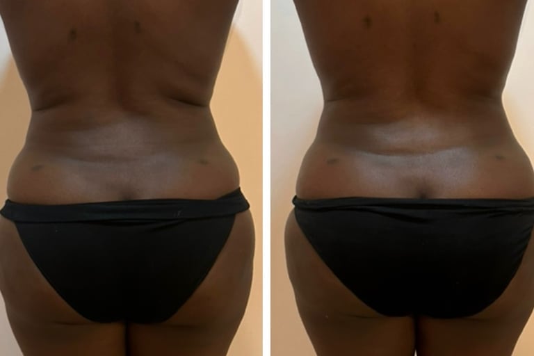 Mesoestetic Bodyshock results – body sculpting NYC