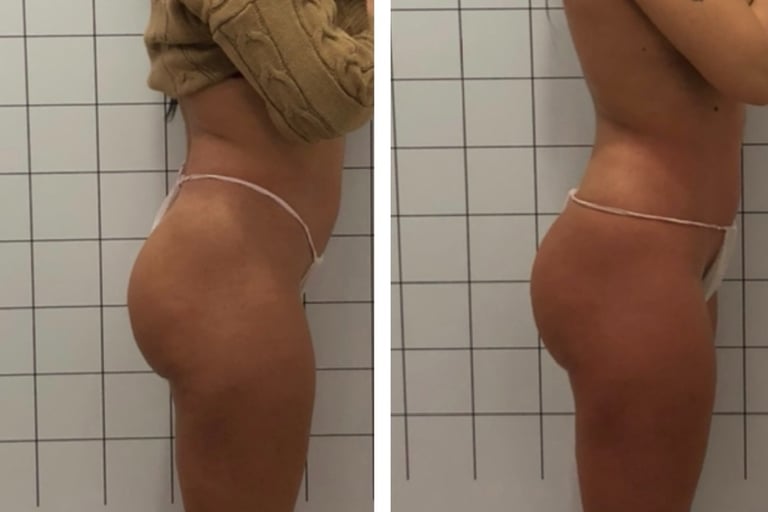 Body contouring NYC – before and after results