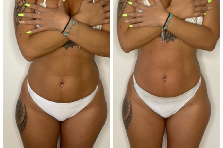 RF tightening and drainage – sculpting results NYC
