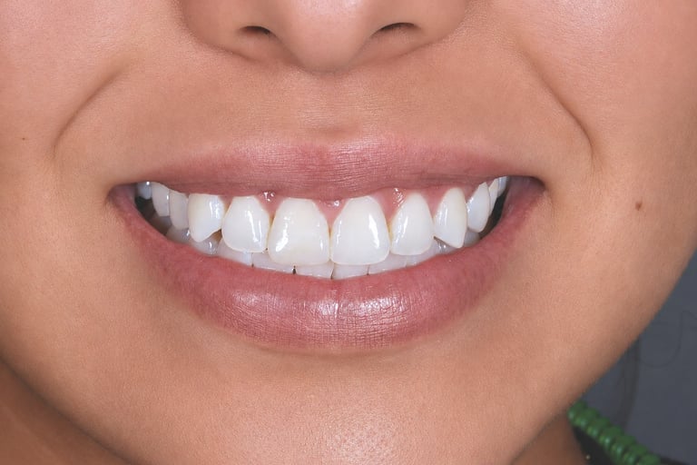 Paciente con sonrisa blanca después de tratamiento de blanqueamiento dental realizado por el Dr. Leo