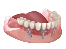 All-on-4 Türkei İzmir — festsitzende Vollversorgung auf vier Implantaten bei Designed Smiles