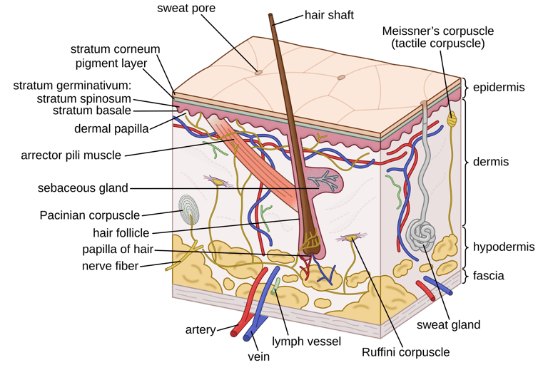 Diagram showing sweat gland duct blocked by dead cells and bacteria, causing trapped sweat and infla