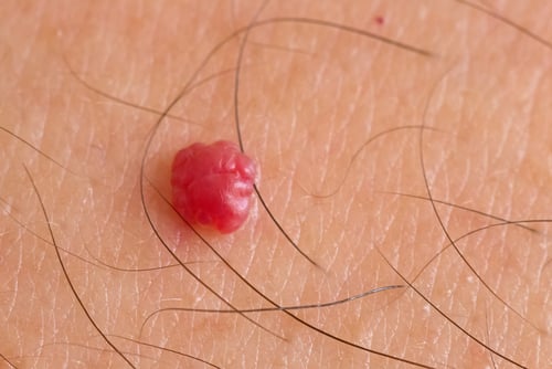 LASER treatment of cherry angiomas in Gateshead